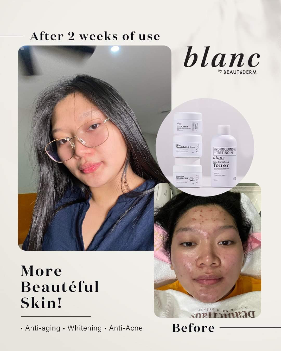Blanc Set (120 ml Toner and 20gm creams, good for 2 months use) with FREEBIES
